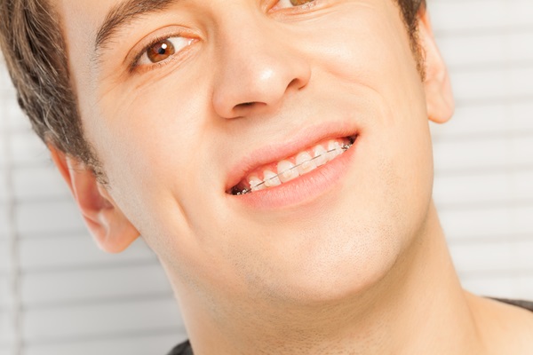 Things You May Not Have Known About Clear Braces