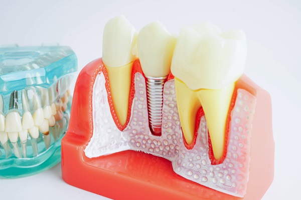 What Is A Dental Crown And When Do You Need One?