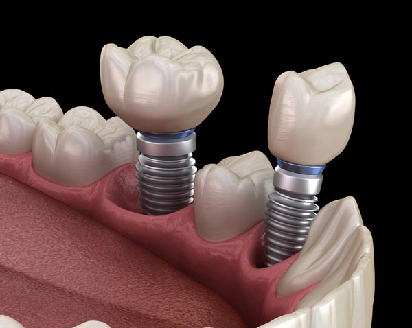 Dental Implants: Replace Your Missing Teeth - Impladent Implant & Cosmetic Dentistry Anaheim California