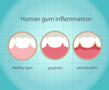 Gum Disease