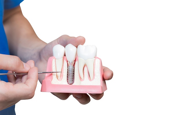 How To Find An Experienced Implant Dentist