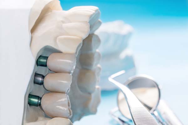 Implant Supported Dentures Anaheim, CA