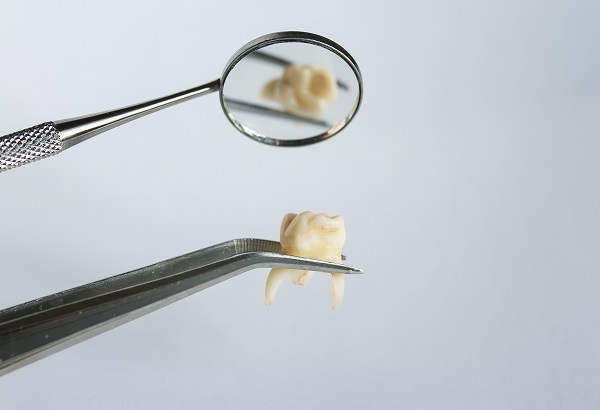 Tooth Extraction Anaheim, CA