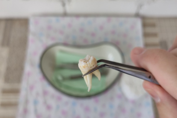 Quick Guide To Wisdom Teeth Extraction